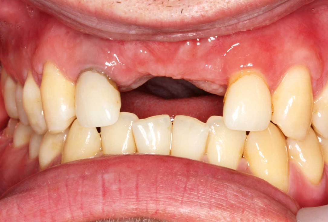 Ridge augmentation in the maxilla with maxgraft® bonebuilder in the aesthetic zone - Dr. M. Kristensen