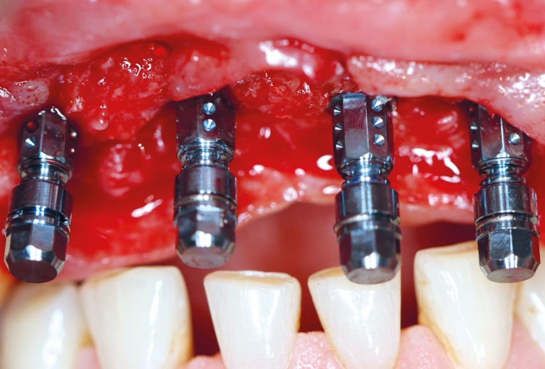 botiss maxgraft® bonebuilder aesthetic reconstruction - Clinical case