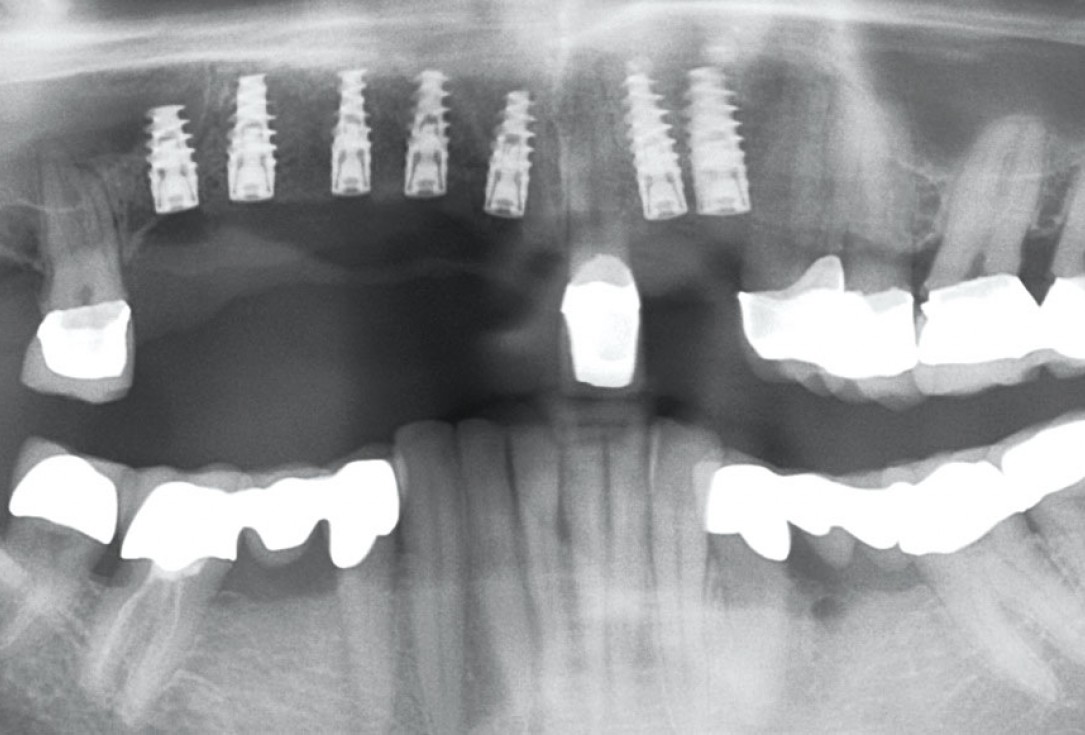 botiss maxgraft® bonebuilder for atrophic maxilla reconstruction - Clinical case