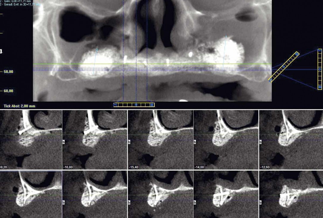 botiss maxgraft® bonebuilder for maxilla reconstruction - Clinical case
