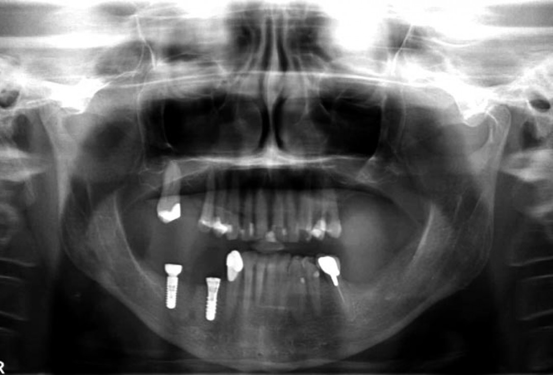 Block augmentation with maxgraft® in the mandible - PD Dr. Dr. F. Kloss