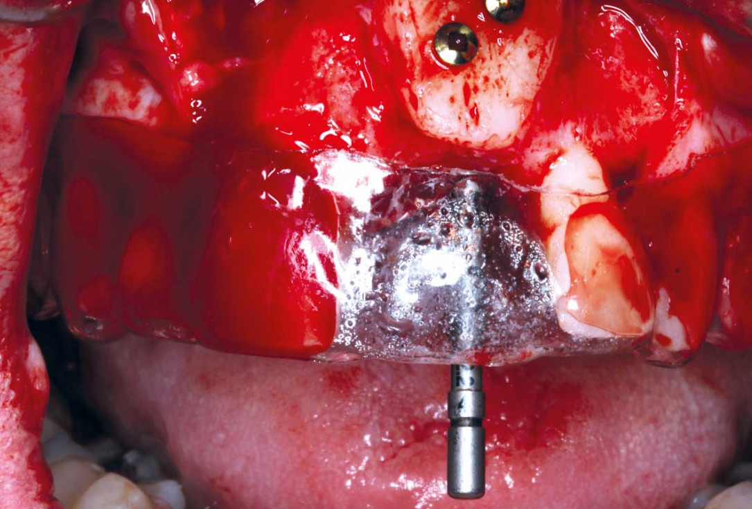 Block grafting in the aesthetic zone with maxgraft®, Jason® membrane and cerabone® - Dres. H. Maghaireh and V. Ivancheva