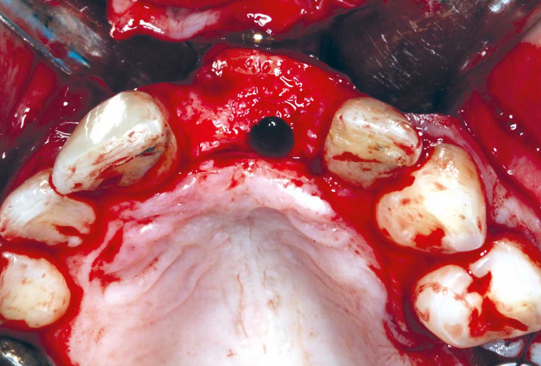 Block grafting in the aesthetic zone with maxgraft®, Jason® membrane and cerabone® - Dres. H. Maghaireh and V. Ivancheva