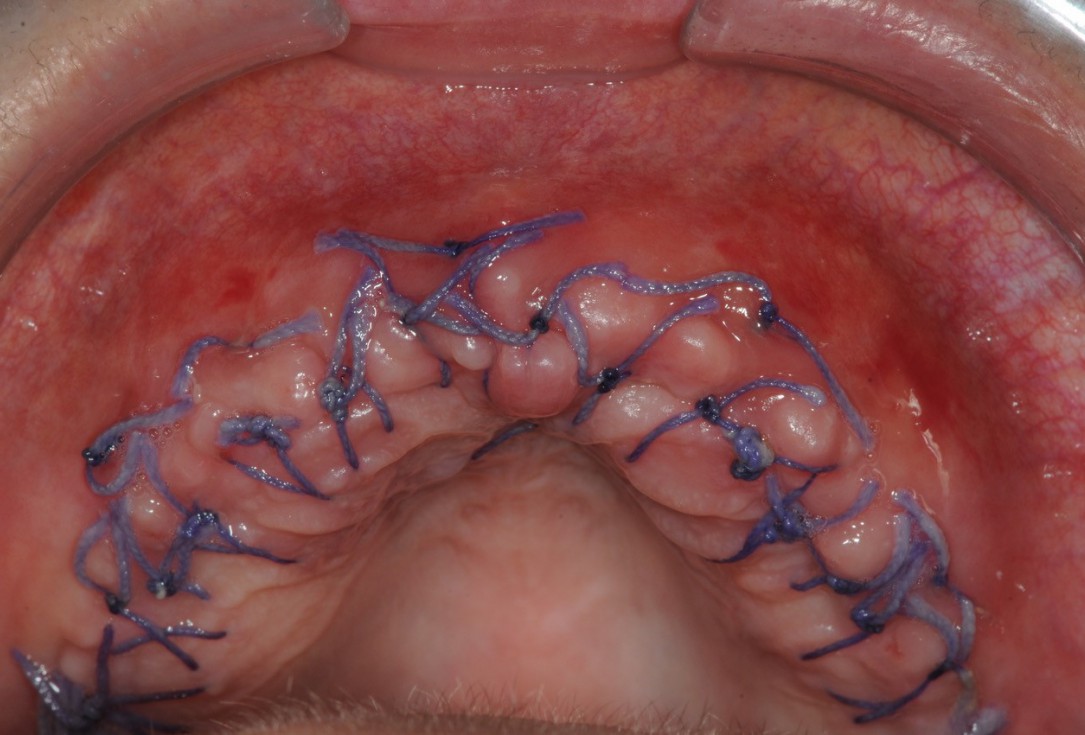 Reconstruction of maxillary ridge with maxgraft® block - Amit Patel