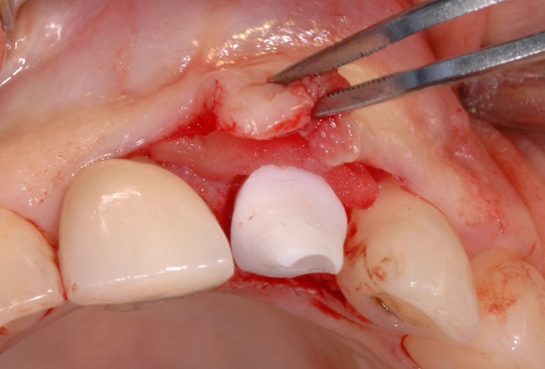 GBR together with soft tissue augmentation with mucoderm® and maxresorb® - Scherg