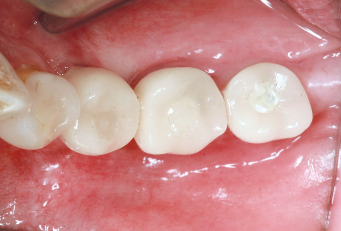 maxgraft® cortico at free-end situation in the mandible - J. Kielhorn