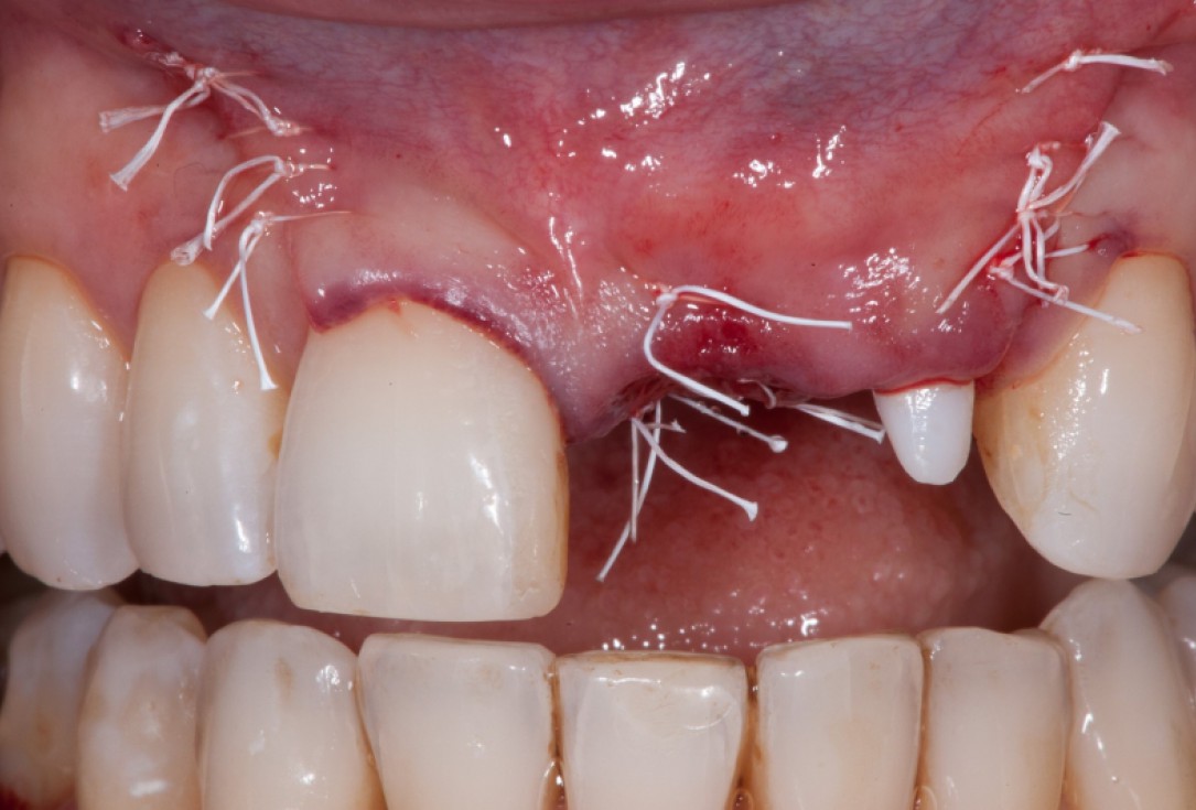 Augmentation with maxgraft® cortico - Dr. K. Chmielewski