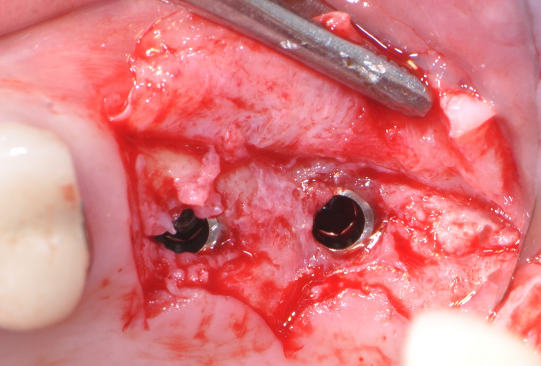 Sinus lift with simultaneous implantation with cerabone® and collprotect® membrane - clinical case Dr. Victor Kalenchuk