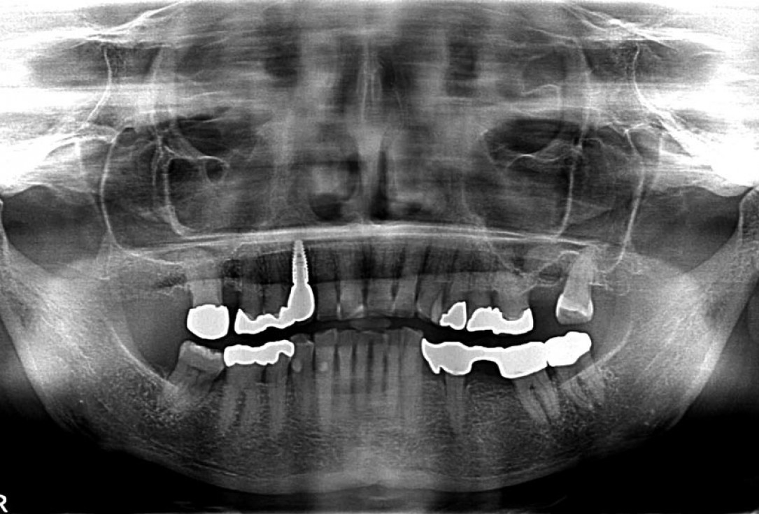 Block augmentation with maxgraft® in the maxilla - PD Dr. Dr. F. Kloss