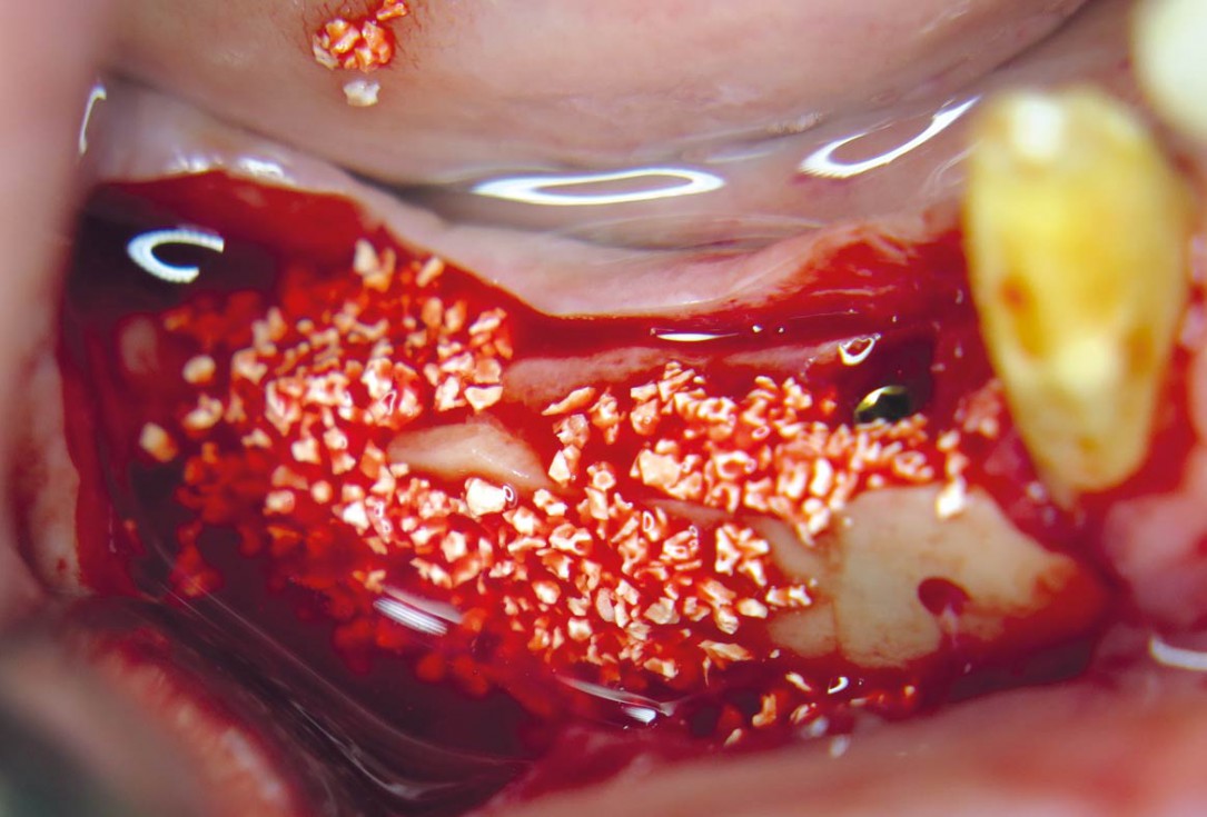Horizontal ridge augmentation with maxgraft® cortico - M.Sc. E. Kapogianni