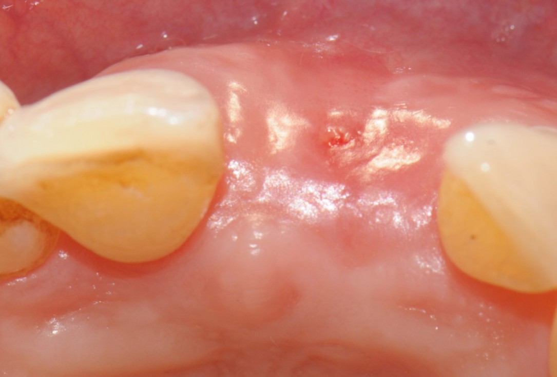 14/18 Tooth extraction and socket sealing with mucoderm® - Dr. A. Rossi