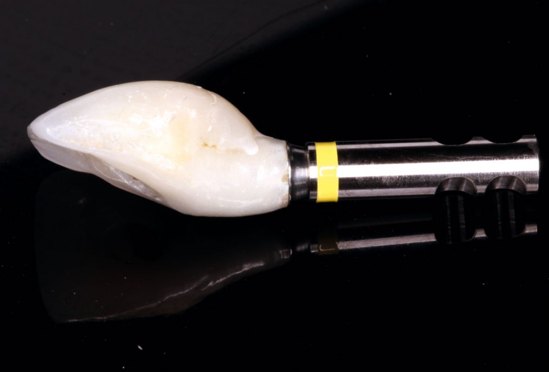 Delayed implant placement with GBR and soft tissue augmentation at the aesthetic area  -  2 years follow up – Dr. H. Maghaireh & Dr. V. Ivancheva