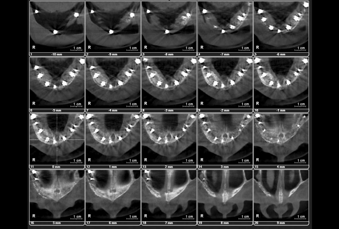 Full arch GBR using botiss cerabone®, maxgraft® and Jason® membrane with simultaneous implantation of 6 Straumann® implants - Dres. A. Signorio and G. Molina