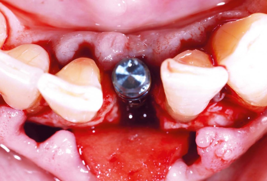 botiss cerabone and mucoderm for bone regeneration and implant supported rehabilitation of a periodontally involved incisor - clinical case