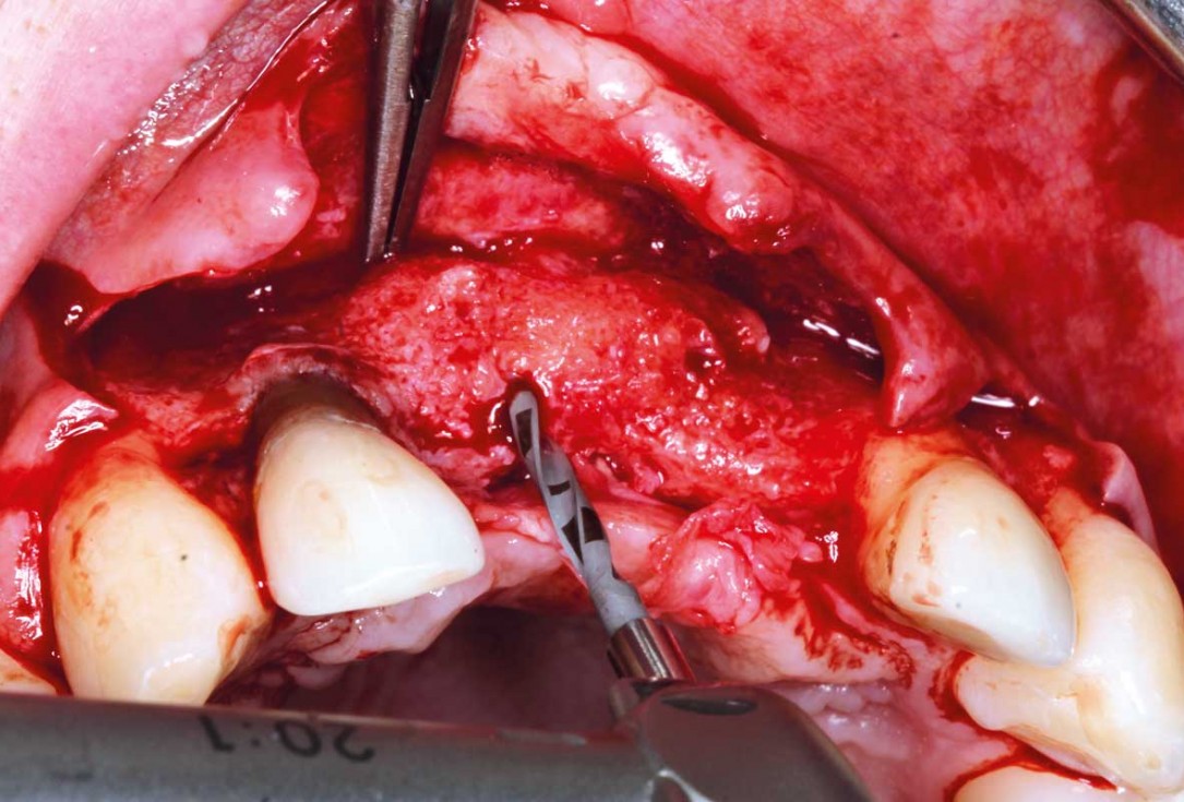 Ridge augmentation in the maxilla with maxgraft® bonebuilder in the aesthetic zone - Dr. M. Kristensen