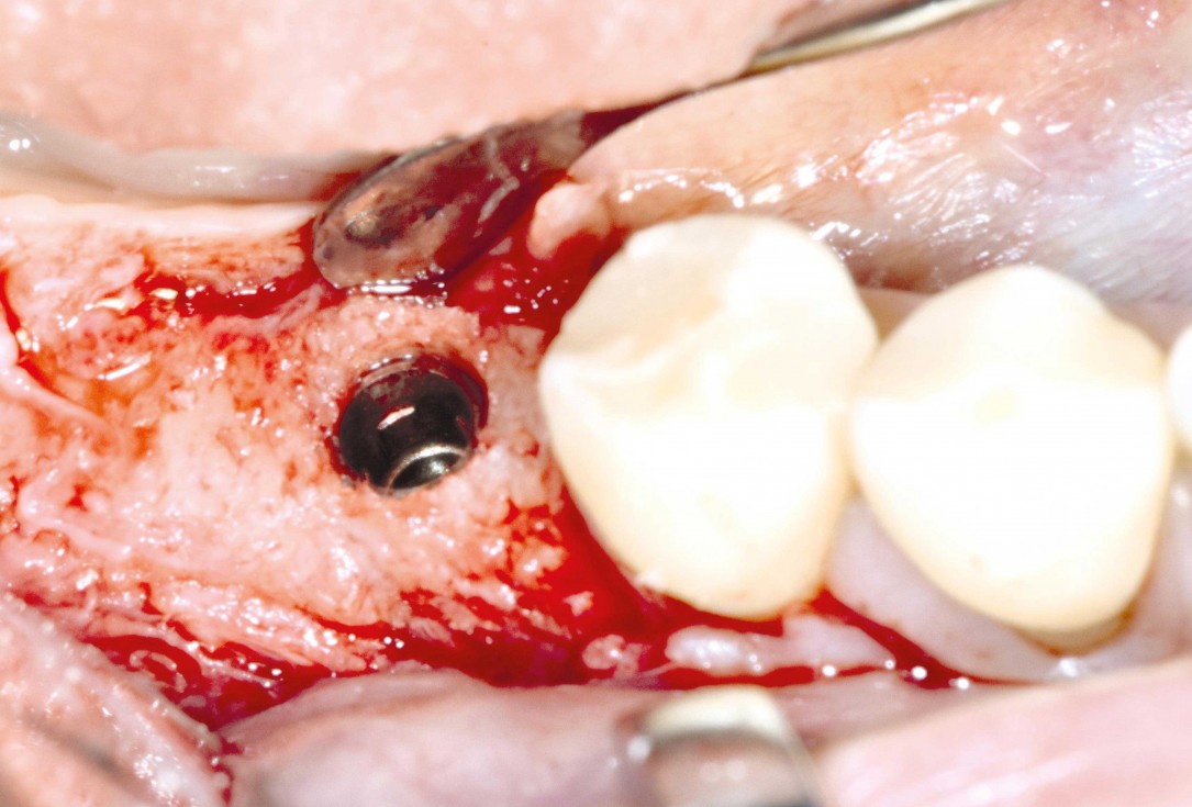 Ridge augmentation in the mandible with maxgraft® bonebuilder– Dr. R. Morger