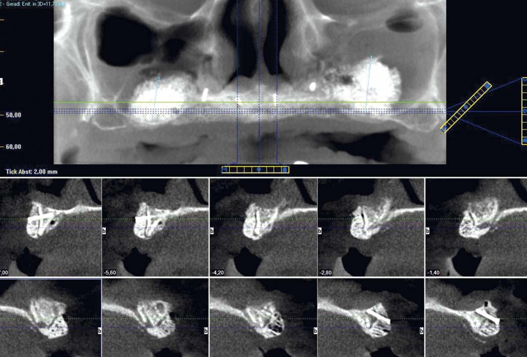 botiss maxgraft® bonebuilder for maxilla reconstruction - Clinical case