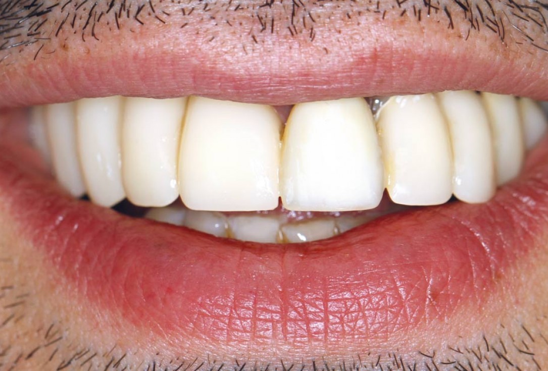 botiss maxgraft® bonebuilder for atrophic maxilla reconstruction - Clinical case