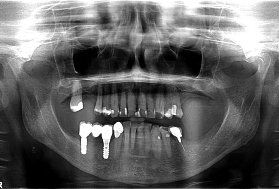 Block augmentation with maxgraft® in the mandible - PD Dr. Dr. F. Kloss
