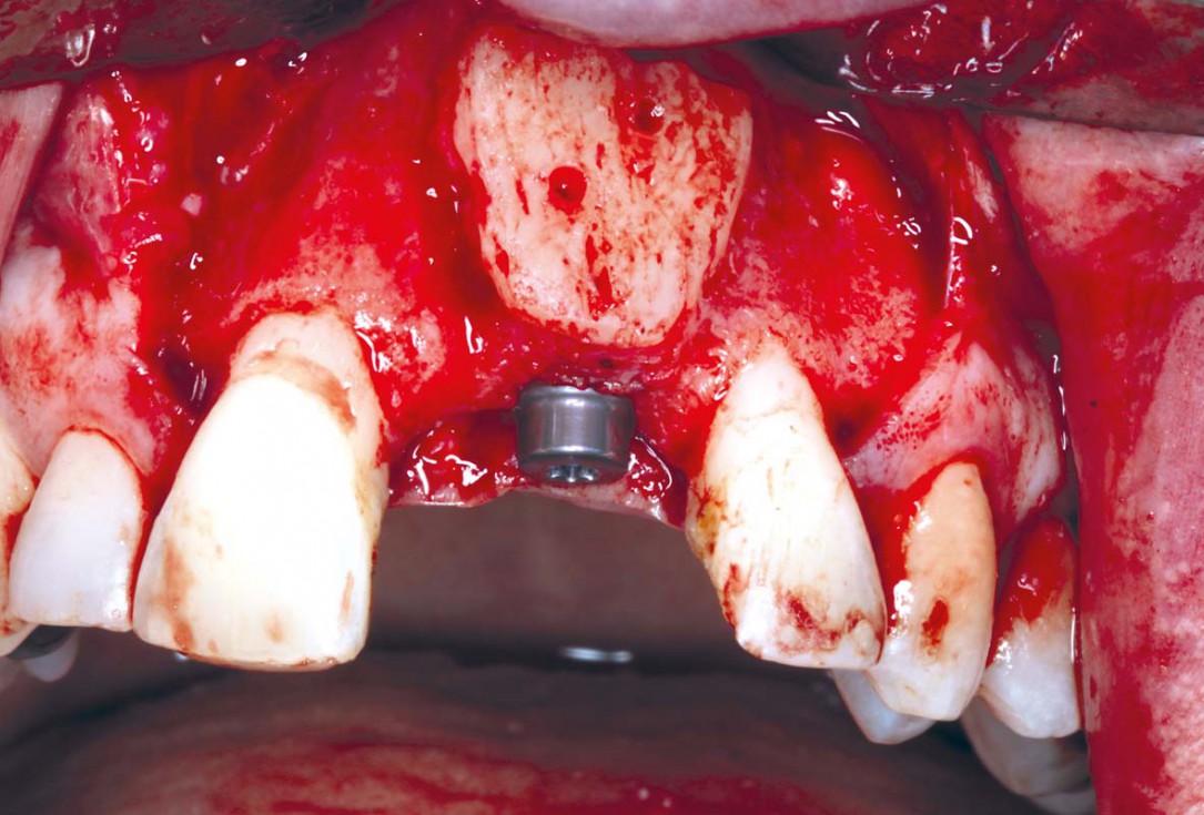 Block grafting in the aesthetic zone with maxgraft®, Jason® membrane and cerabone® - Dres. H. Maghaireh and V. Ivancheva