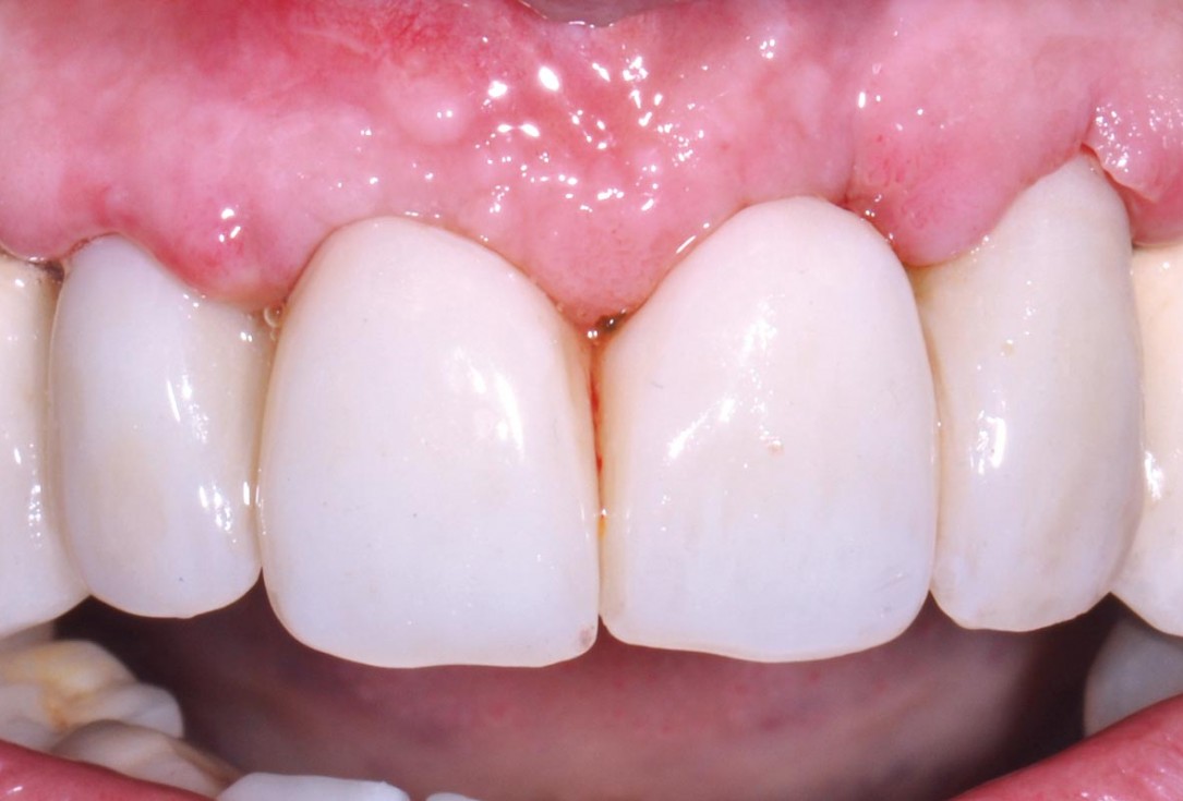 Hard and soft tissue management in immediate restoration