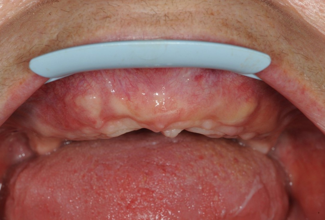 Reconstruction of maxillary ridge with maxgraft® block - Amit Patel