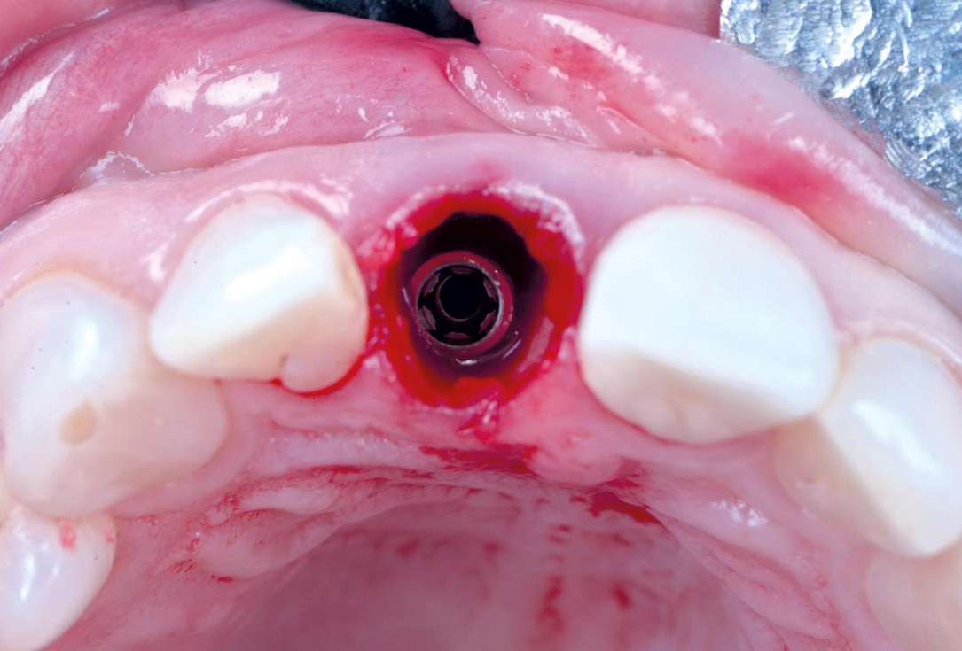 Excellent aesthetic result of buccal augmentation with mucoderm® and maxgraft® after immediate implant placement - 3-years follow-up - Dr. A. Puišys 