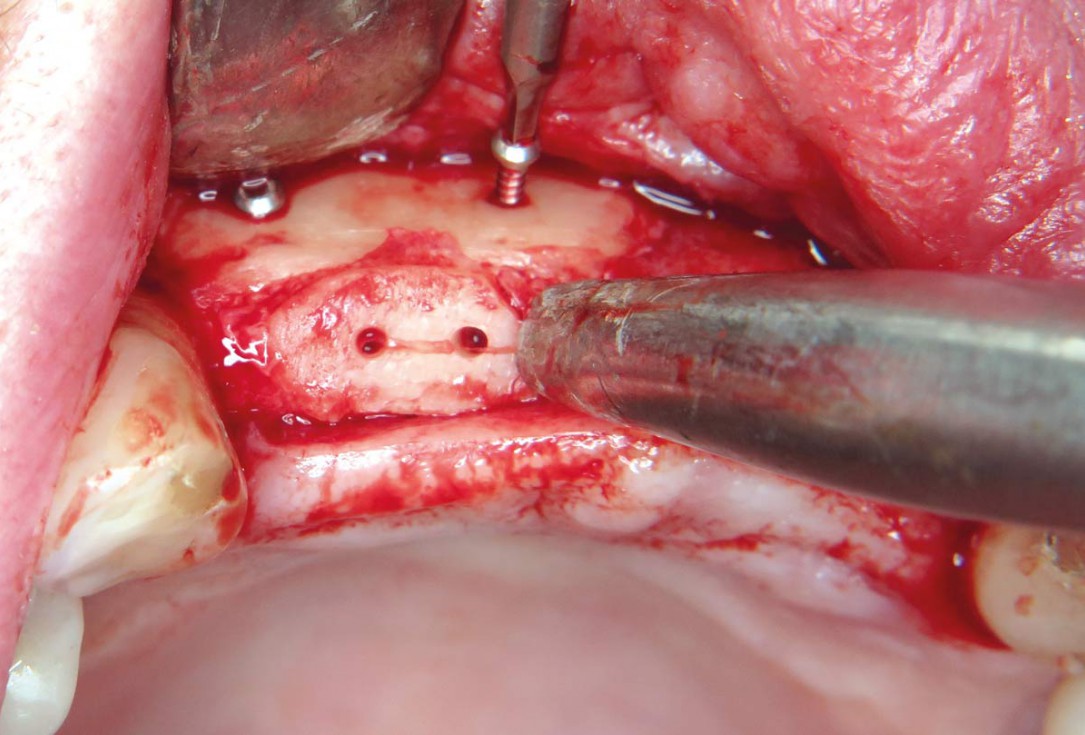 Three-dimensional augmentation with maxgraft® cortico - M.Sc. E. Kapogianni