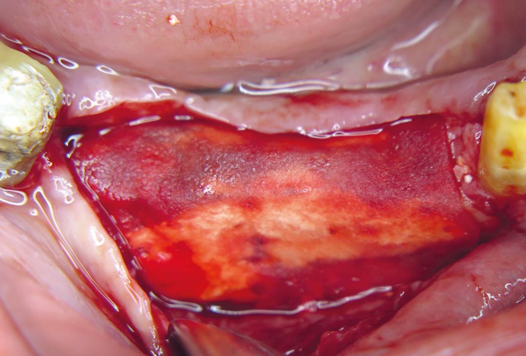 Horizontal ridge augmentation with maxgraft® cortico - M.Sc. E. Kapogianni