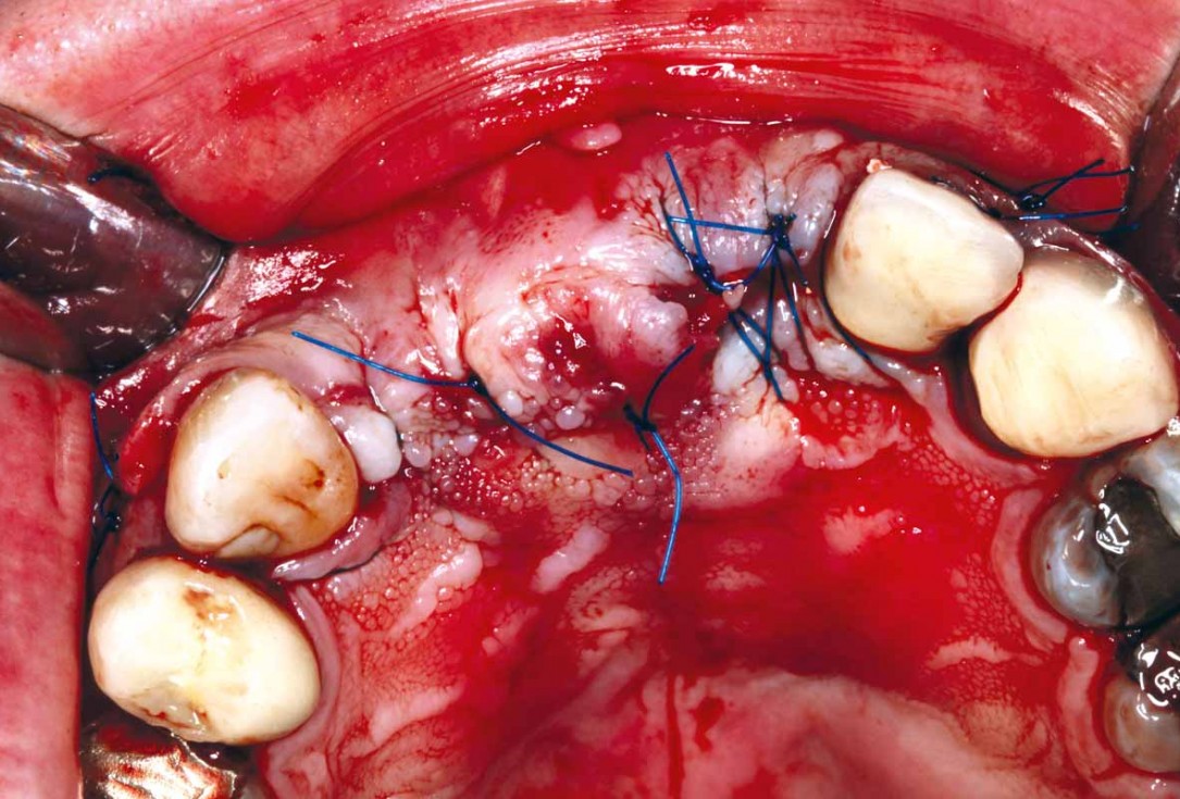 GBR and soft tissue augmentation with cerabone® and mucoderm® - H. Maghaireh & V. Ivancheva