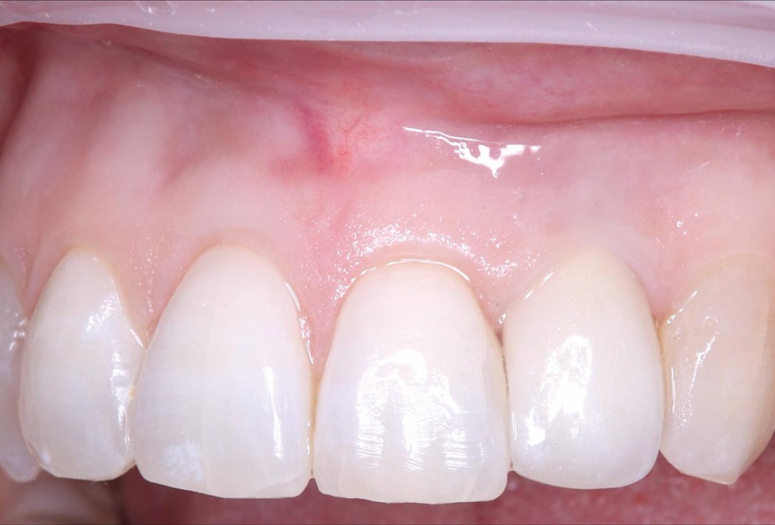 Simultaneous GBR and implantation using maxgraft® granules and autologous bone