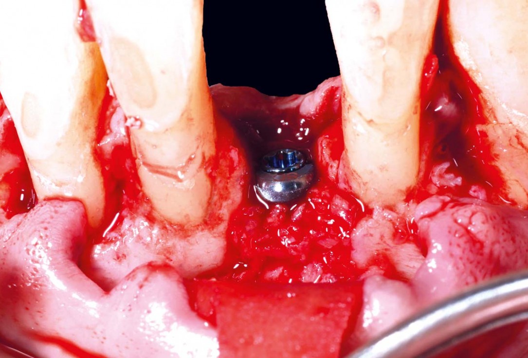 botiss cerabone and mucoderm for bone regeneration and implant supported rehabilitation of a periodontally involved incisor - clinical case