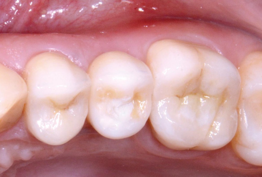 Full bone regeneration in extraction socket augmented with maxgraft® and Jason® membrane – Dr. C. Landsberg