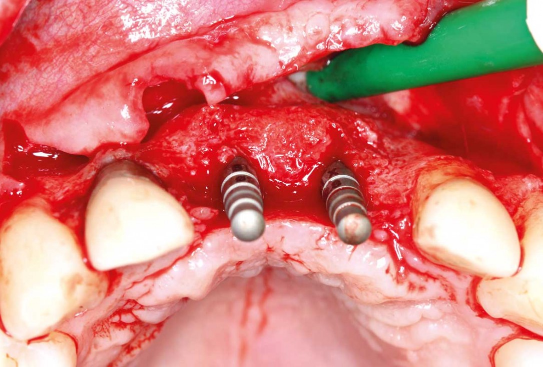 Ridge augmentation in the maxilla with maxgraft® bonebuilder in the aesthetic zone - Dr. M. Kristensen