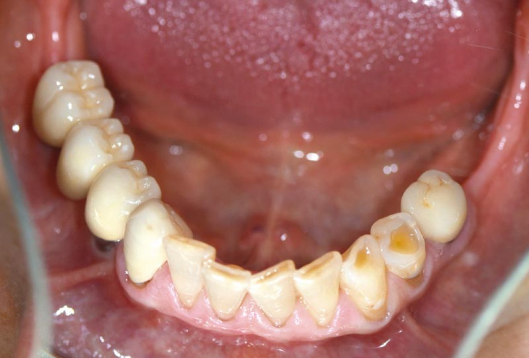 Block augmentation with maxgraft® in the mandible - PD Dr. Dr. F. Kloss
