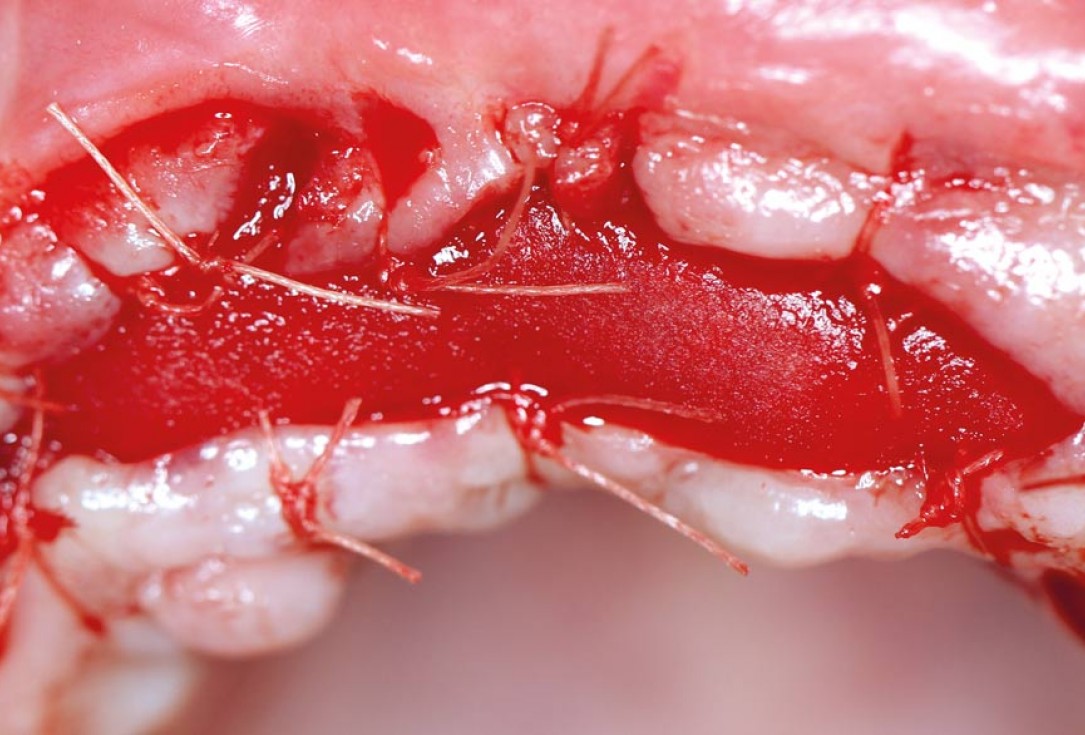 botiss maxgraft® bonebuilder aesthetic reconstruction - Clinical case