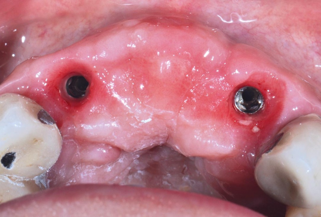 Hard and soft tissue management in immediate restoration