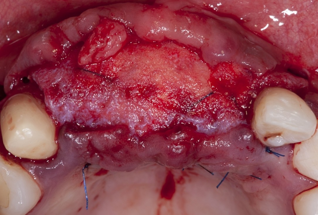 Block augmentation with maxgraft® block and mucoderm® - Dr. K. Chmielewski