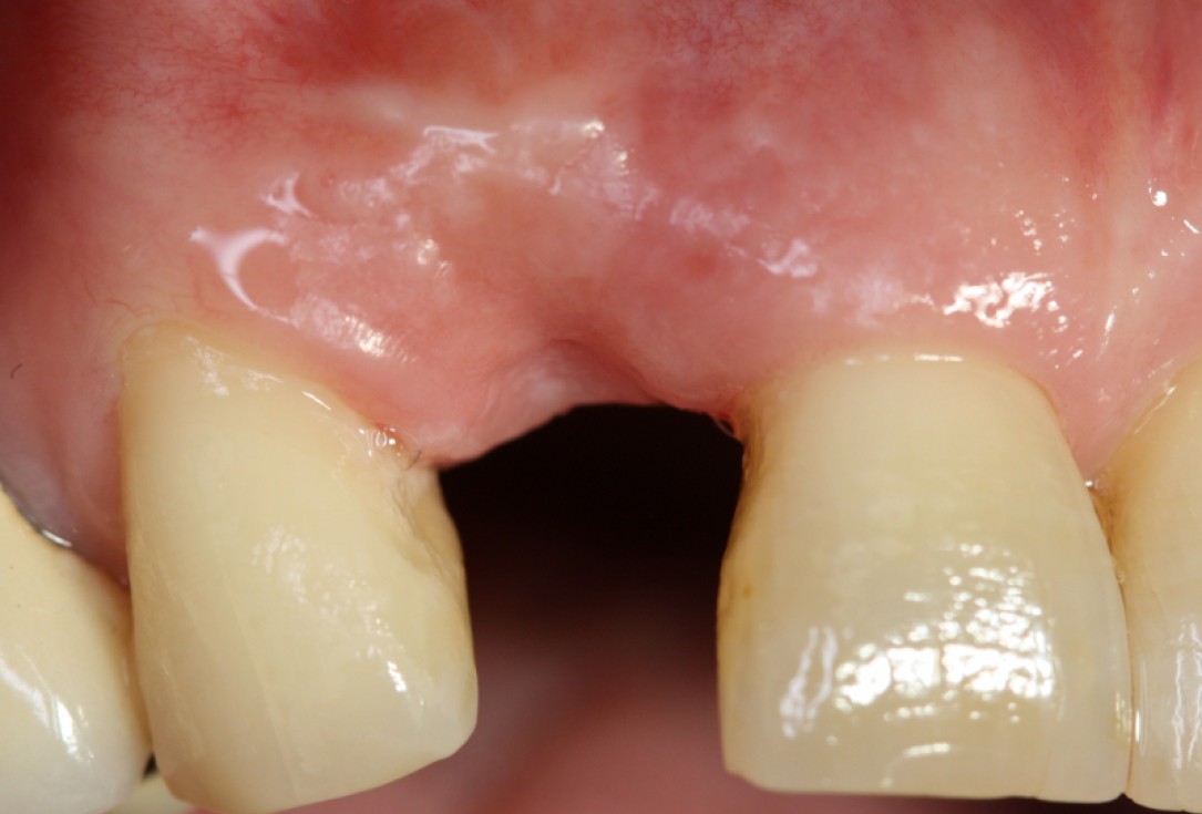 15/20 GBR with maxresorb® and Jason® membrane - Prof. Dr. Dr. D. Rothamel