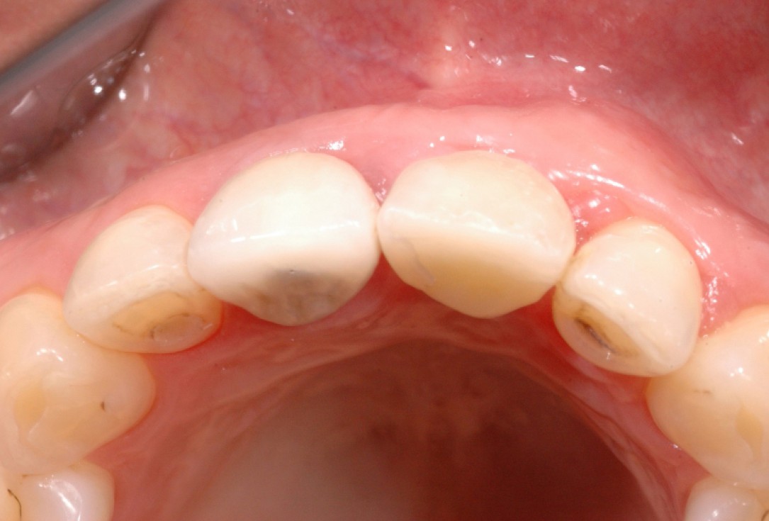 GBR together with soft tissue augmentation with mucoderm® and maxresorb® - Scherg