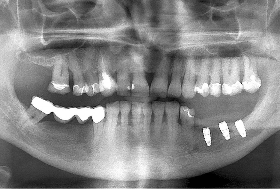 maxgraft® cortico at free-end situation in the mandible - J. Kielhorn