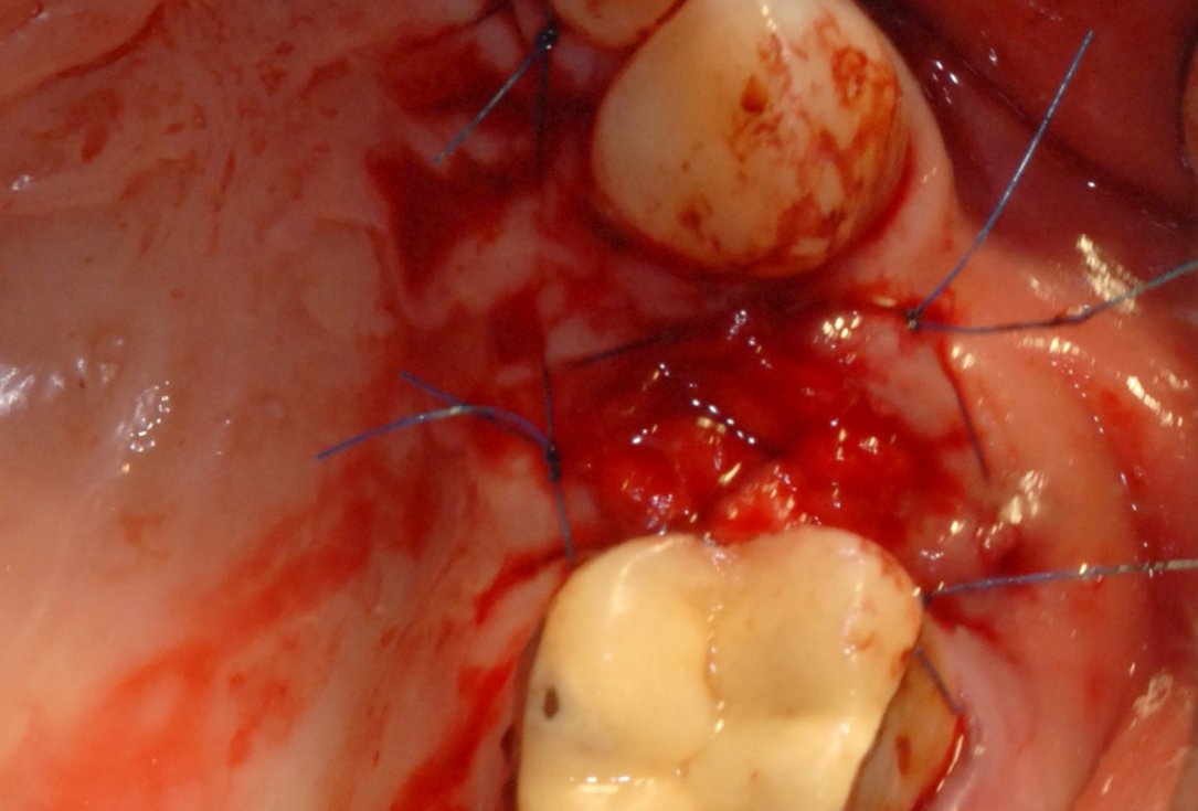 Ridge preservation with cerabone® and Jason® membrane - Dr. Derk Siebers