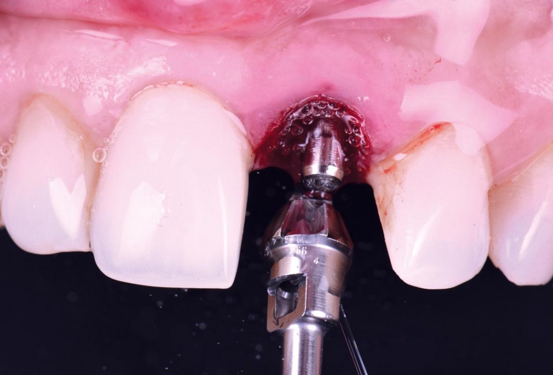Excellent aesthetic result of buccal augmentation with mucoderm® and maxgraft® after immediate implant placement - 3-years follow-up - Dr. A. Puišys 