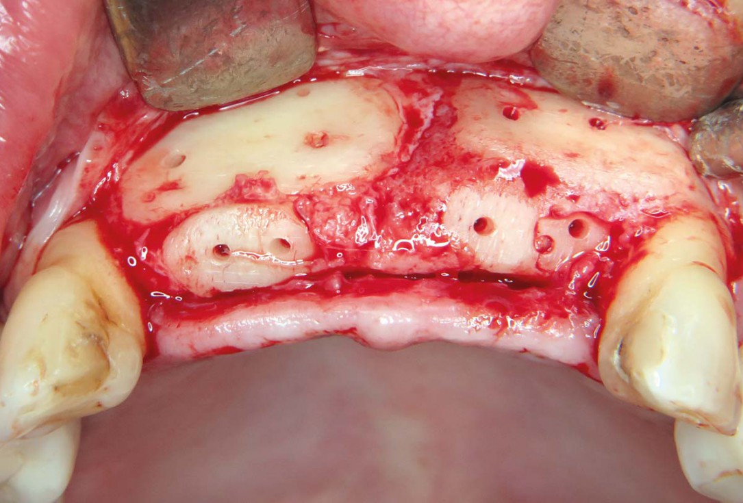 Three-dimensional augmentation with maxgraft® cortico - M.Sc. E. Kapogianni