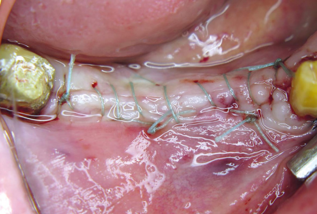 Horizontal ridge augmentation with maxgraft® cortico - M.Sc. E. Kapogianni