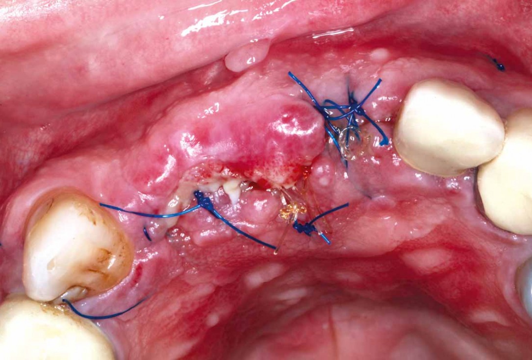 GBR and soft tissue augmentation with cerabone® and mucoderm® - H. Maghaireh & V. Ivancheva