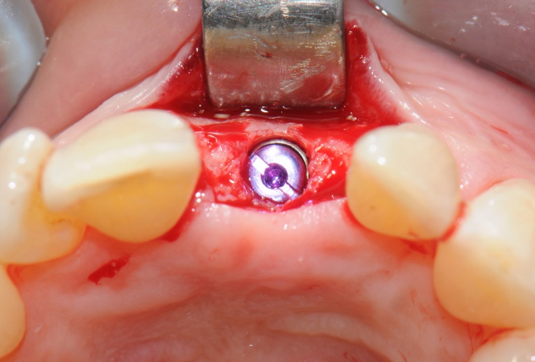 16/18 Tooth extraction and socket sealing with mucoderm® - Dr. A. Rossi