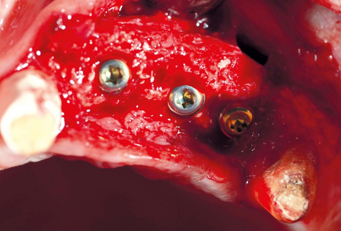 Reconstruction of Anterior Maxilla with maxgraft® bonebuilder – Dr. B. Han