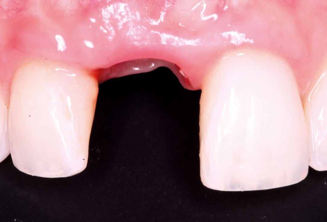 Delayed implant placement with GBR and soft tissue augmentation at the aesthetic area  -  2 years follow up – Dr. H. Maghaireh & Dr. V. Ivancheva