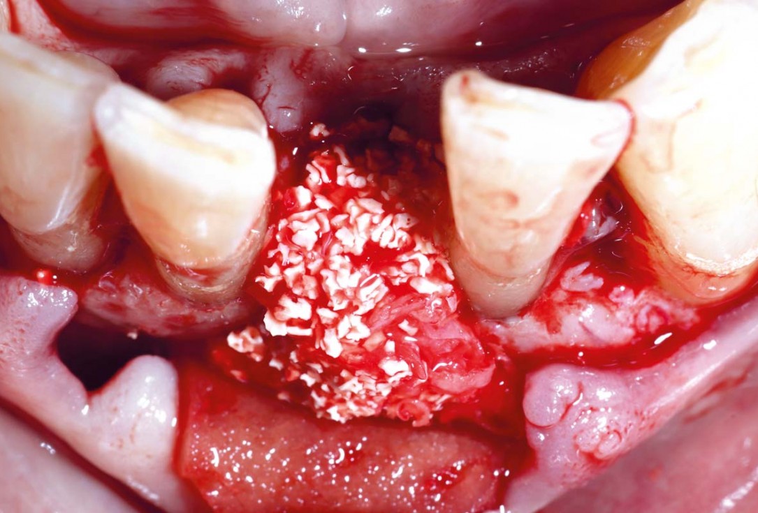 botiss cerabone and mucoderm for bone regeneration and implant supported rehabilitation of a periodontally involved incisor - clinical case